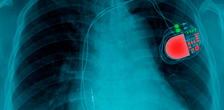 Marcapasos en adultos mayores